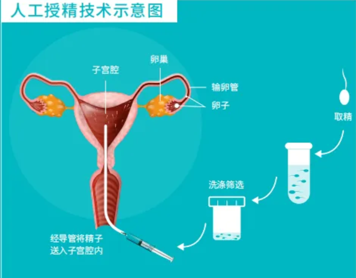 什么是人工授精