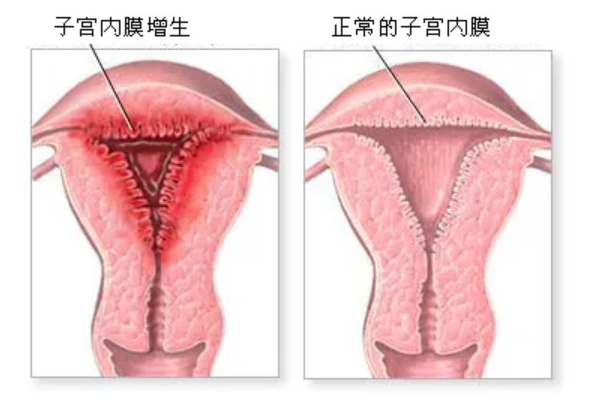 什么是子宫内膜增厚