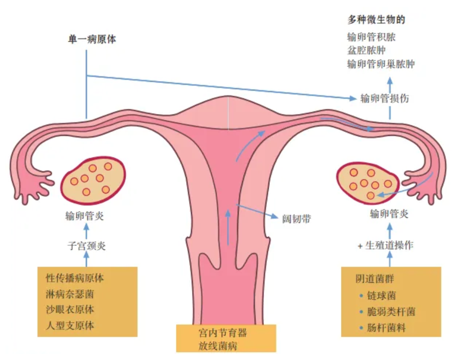 什么是慢性盆腔炎