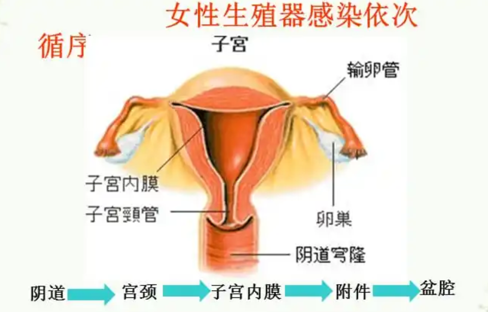 盆腔炎的原因