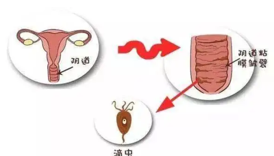 什么是滴虫性阴道炎