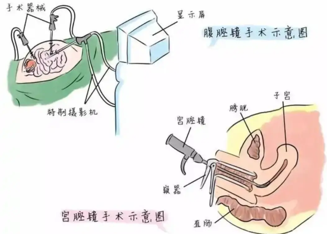 宫腔镜检查可以提高妊娠率吗？