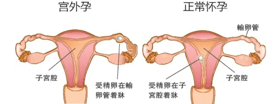 验出怀孕后，我什么时候能知道是否宫外孕？