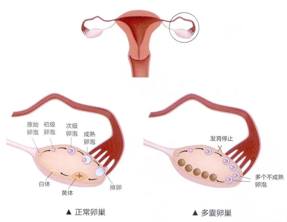 多囊患者不用担心，基本都能怀上孩子