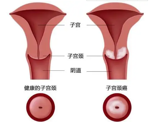 宫颈糜烂该怎么检查，能不能去试管婴儿治疗？