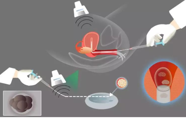 试管婴儿取卵手术和胚胎移植手术