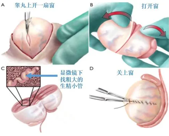 什么是睾丸发育不良