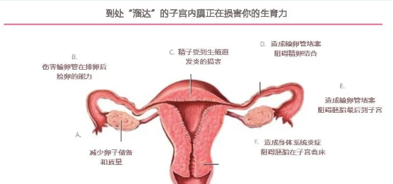 子宫内膜异位症术后，最佳怀孕时机