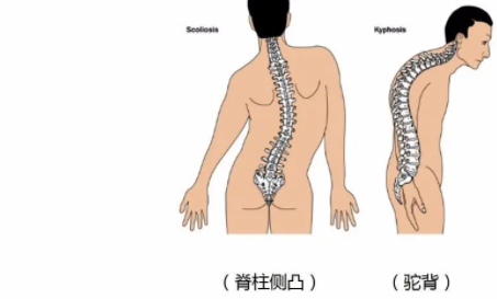 软骨发育不全做三代试管筛查有用吗