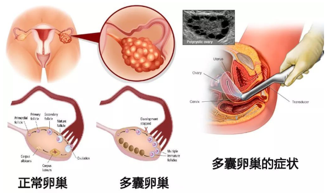 PCOS促排：优选克罗米芬还是来曲唑？