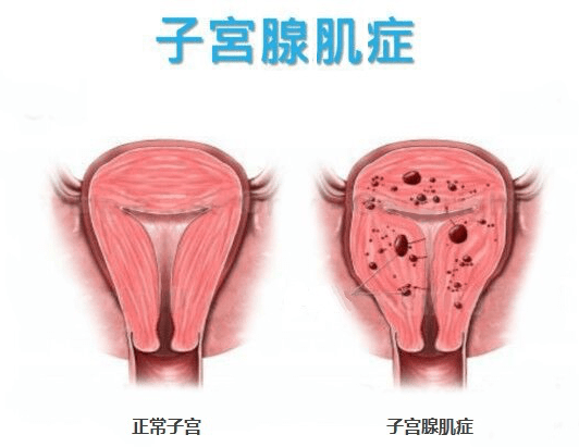 子宫腺肌症会导致子宫内膜变厚吗？