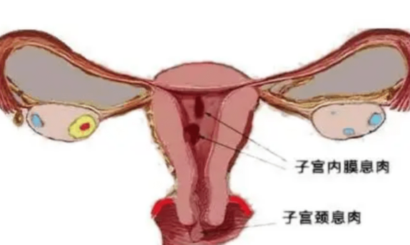 子宫内膜息肉，切了就没事了吗？ 