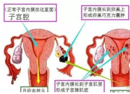 哪些因素是子宫内膜异位症的高危因素？