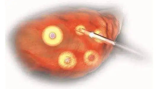 试管取卵越多越好吗