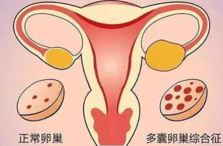 多囊不孕，佛山试管婴儿成功好孕