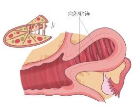 宫腔粘连七年漫漫求子路，试管给了我希望