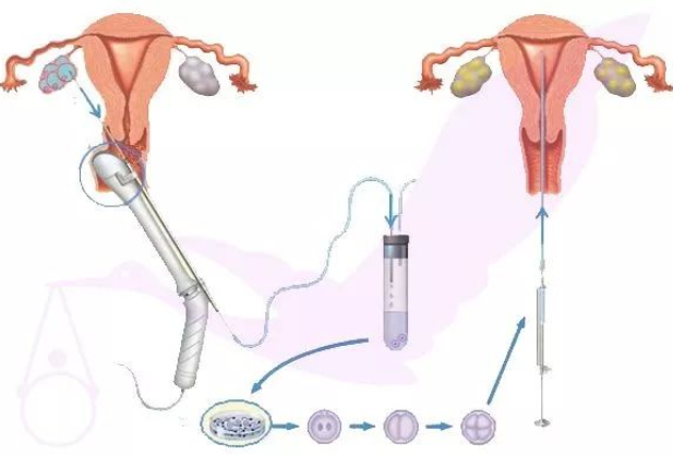 试管取卵需要经历哪些事？3张图告诉你！