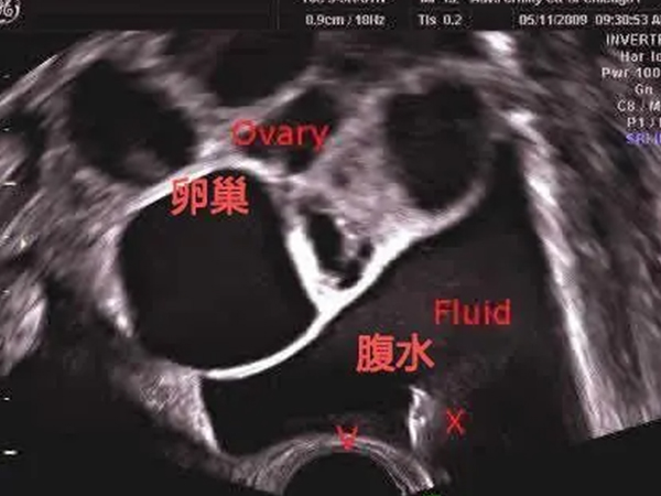 试管试管5大副作用分别是什么？