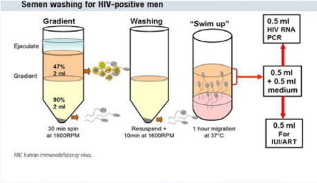 人工授精精子能洗掉传染病吗 hiv精子洗涤技术的流程