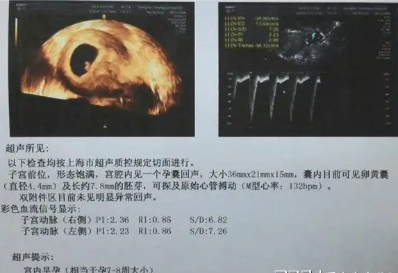 试管移植胎心可以很直接的反应胎儿的情况