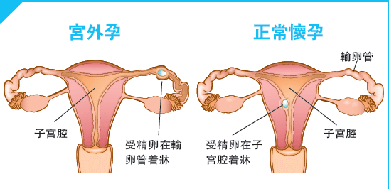 最简单4招辨别是不是宫外孕