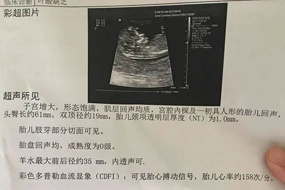 	B超NT值看男女85%的准确率是真的吗，NT单子哪些字母看男女