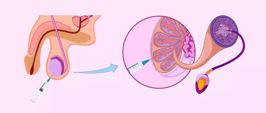 神秘的从“蛋蛋里找精子”手术是怎么样的？