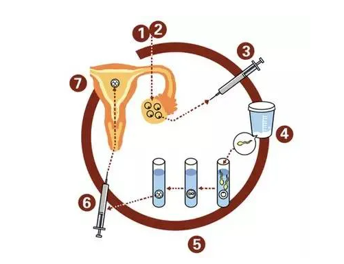 试管都需要宫腔灌注吗？