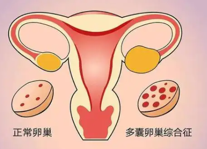 多囊卵巢不来月经还会排卵吗？那怎么怀孕