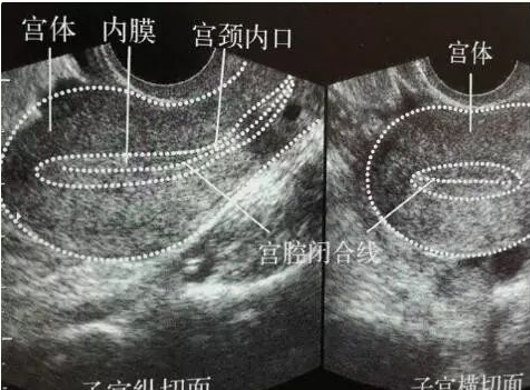 超声是评估子宫形态学特征（附图片讲解）